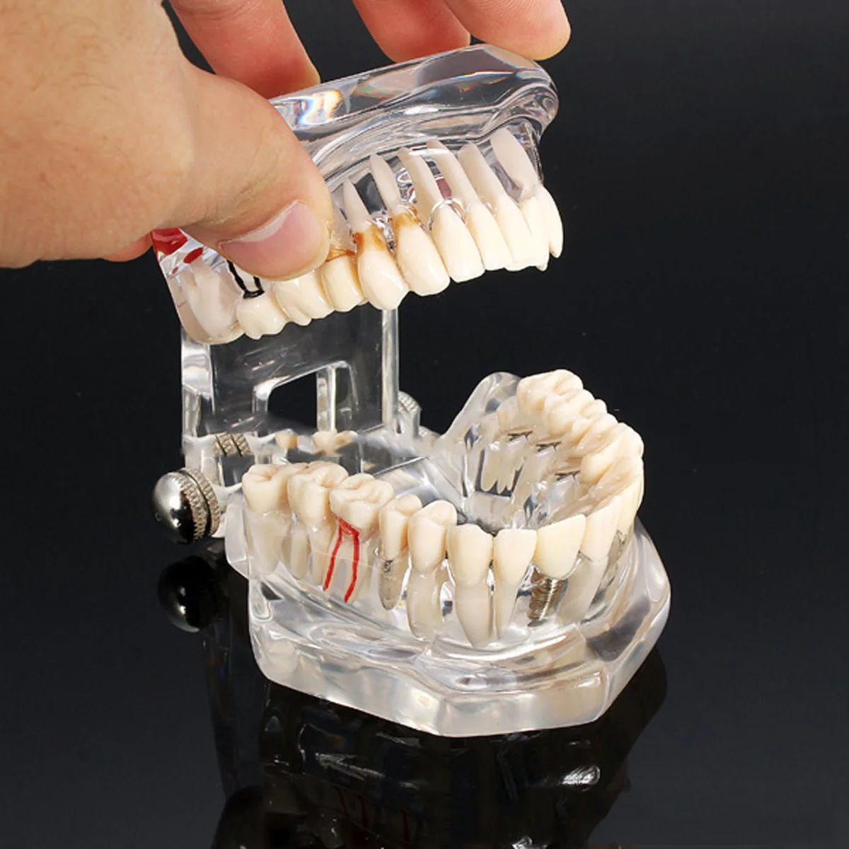 Implantai, Dantų Ligos, Dantų Modelį Su Restauravimo Tiltas Dantų Odontologas Medicinos Mokslo Dantų Ligos Mokymo Studijų Įrankis