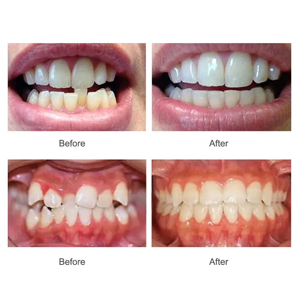 Trimis Etapais Laikiklis Dantų Ortodontinis Dantų Nematomas Straightenin Nustatyti, Silikoninis Dantų Prietaiso Burnos Apsaugą Breketus Dantų Plokštelę