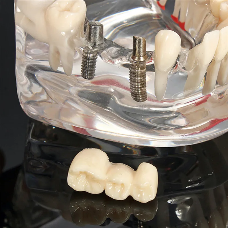 Implantai, Dantų Ligos, Dantų Modelį Su Restauravimo Tiltas Dantų Odontologas Medicinos Mokslo Dantų Ligos Mokymo Studijų Įrankis